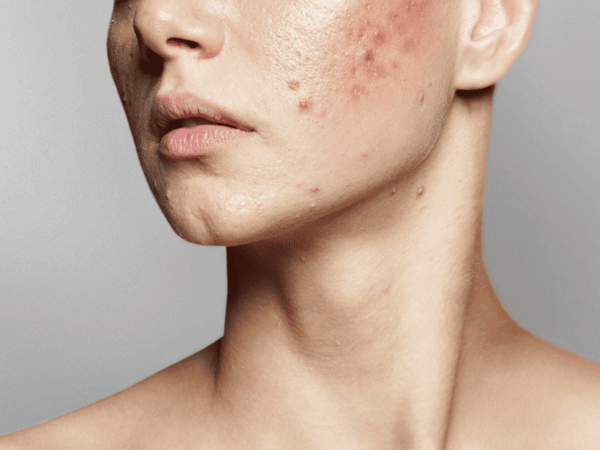 Acne Scars Treatments & What Really Works: A Comprehensive Guide