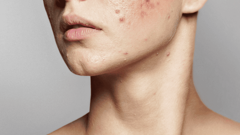 Acne Scar Treatment