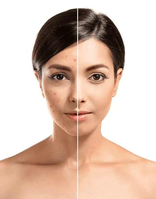 Laser treatments for Acne