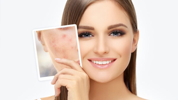 Best Ways to Remove Acne Scars Fast & Naturally