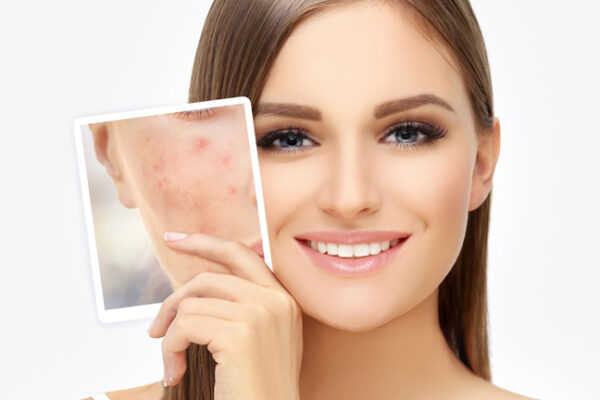 Best Ways to Remove Acne Scars Fast & Naturally