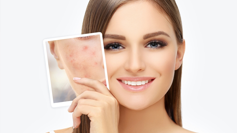 Best Ways To Remove Acne Scars Fast Naturally Fms Skin