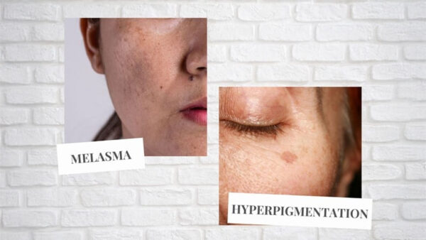Difference Between Melasma and Pigmentation