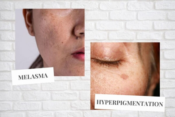 Difference Between Melasma and Pigmentation
