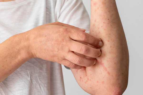 Mupirocin for Bacterial Skin Infections: How It Works & How to Use