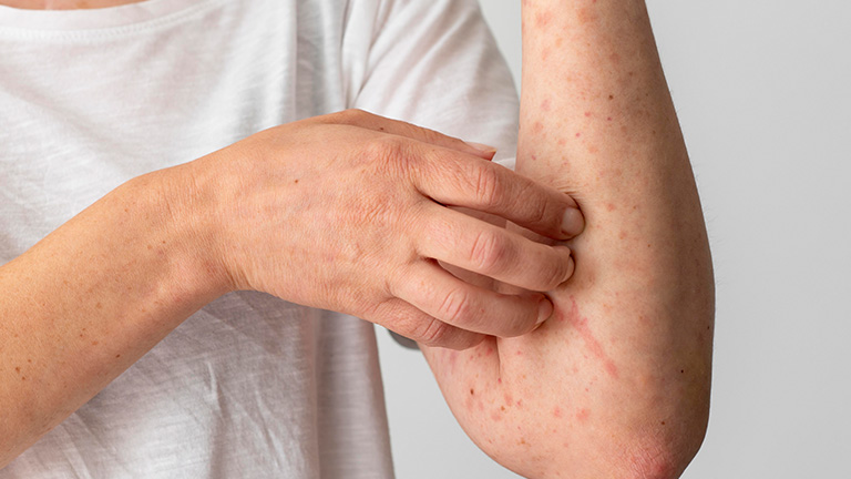 mupirocin for bacterial skin infections