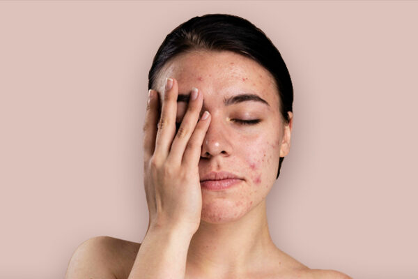 Blood Filled Pimples: Causes, Treatments, Prevention Tips
