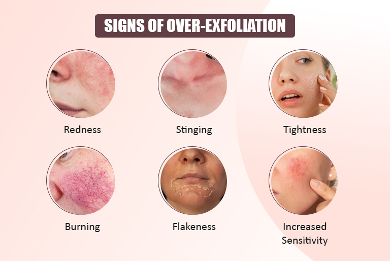 signs of over-exfoliation