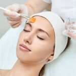 Chemical Peels for Hyperpigmentation