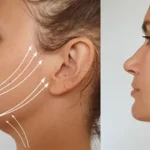 Non Invasive Double Chin Treatments