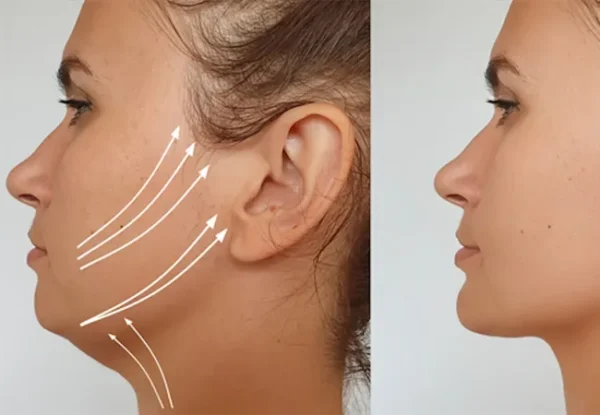 Achieve a Sharper Jawline with Non-Invasive Double Chin Treatment