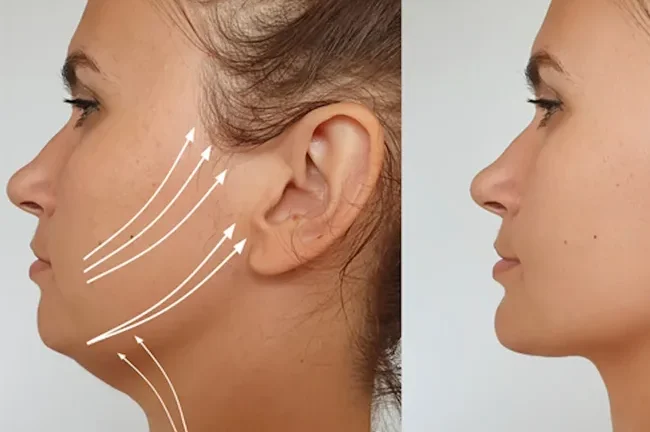 Non Invasive Double Chin Treatments