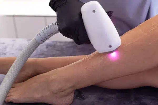 Is Laser Hair Removal Right for Indian Skin? A Dermatologist Explains