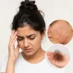 Can stress causes Acne and Hairfall