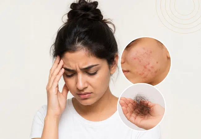 Can stress causes Acne and Hairfall