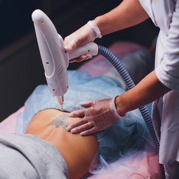 Tattoo Removal in Hyderabad