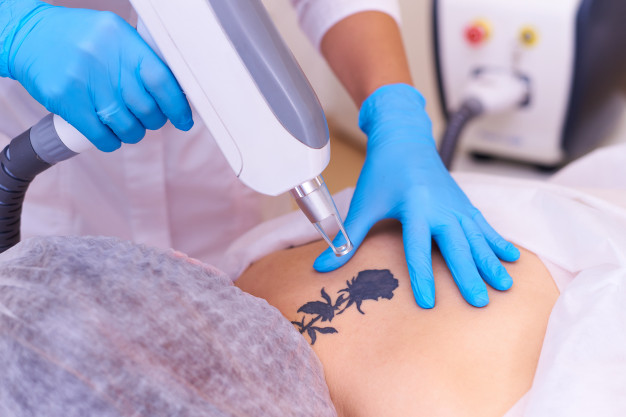 FMS SKIN: Best Tattoo Removal LASER Treatment in Hyderabad