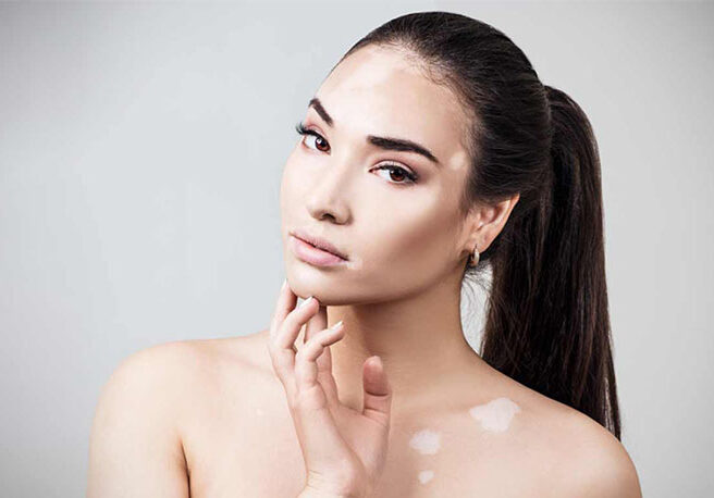 Best Vitiligo Treatment in Hyderabad