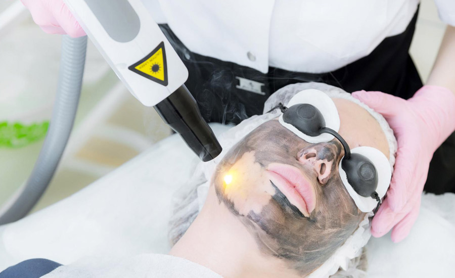 Carbon Laser Peel Treatment in Hyderabad