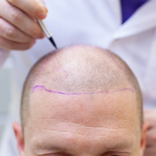 hair-transplant-surgery