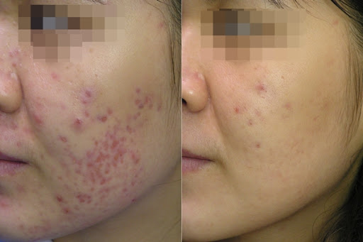 Melasma Treatment