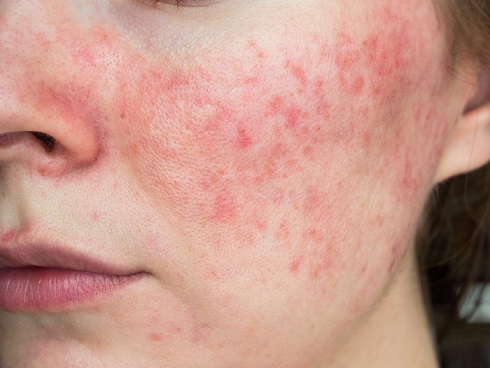 Rosacea treatment in hyderabad