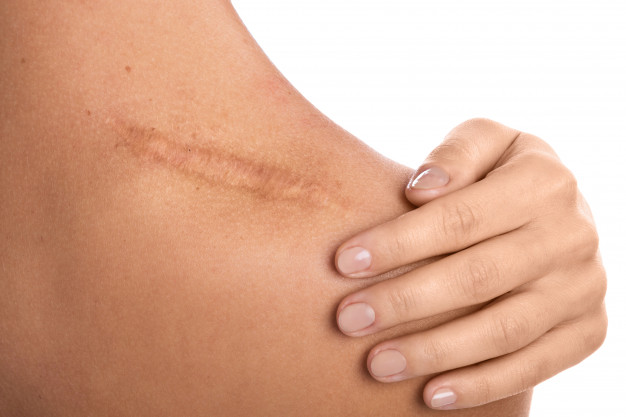 Scars Treatment in hyderabad
