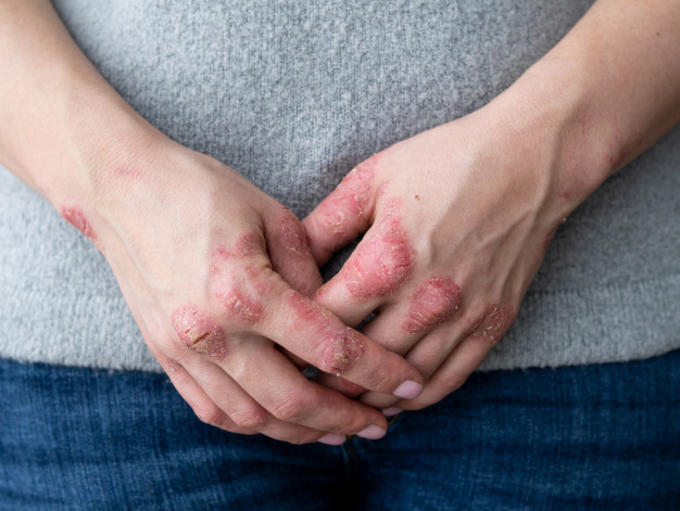 psoriasis treatment in hyderabad