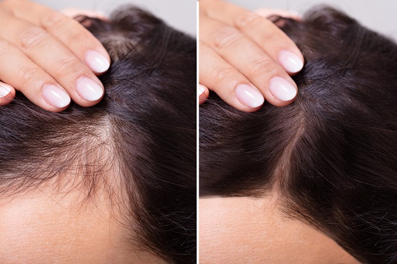 Hair Loss in Females  The 2 Most Common Causes  Saikia Skin Care