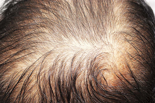 Male Pattern Hair Loss