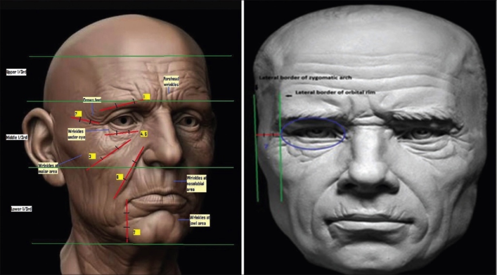 FACIAL AGEING AND VOLUME LOSS