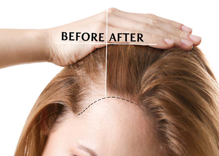 ALOPECIA AREATA TREATMENT