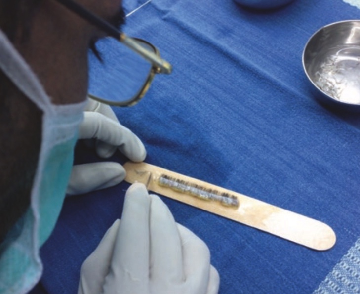 e prepare the graft for transplantation