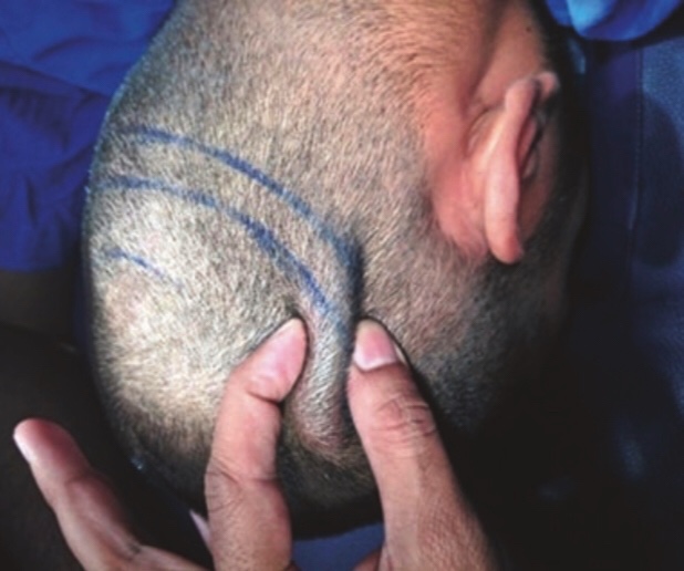 Skin laxity