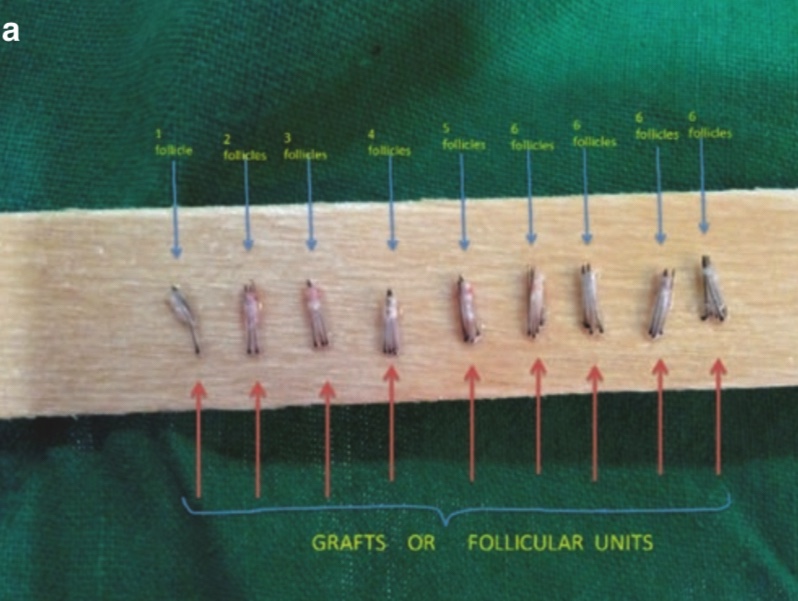 e prepare the graft for transplantation