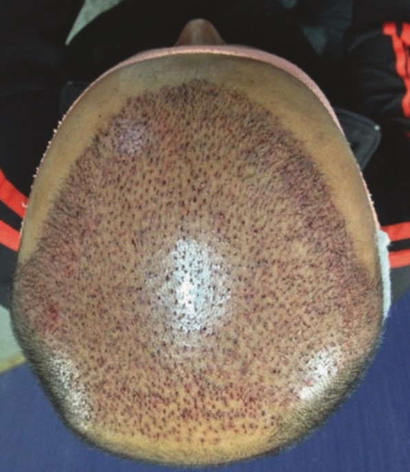 Preparation and Implantation of hair follicles