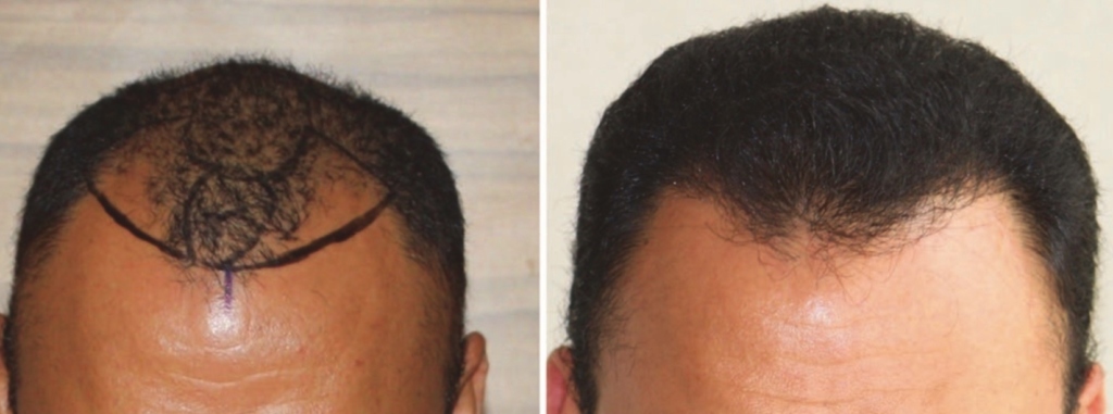 Hair Transplant Results in Women