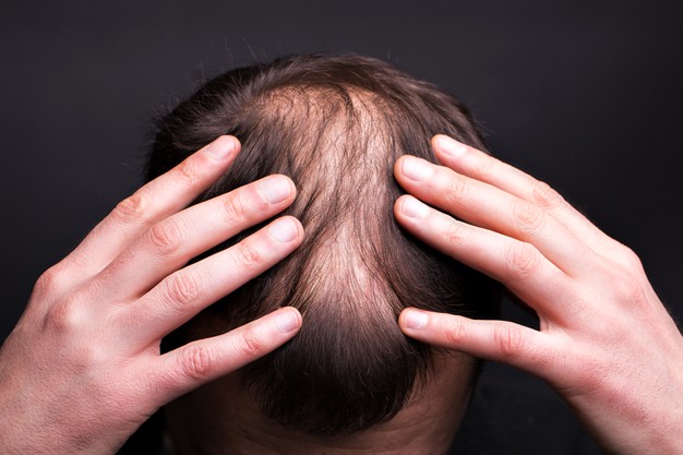 Hair Care Clinic  Hair Loss Treatment  Prp Hair  Vcare Trichology