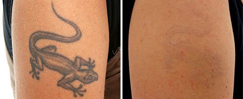 Permanent Tattoo Removal Clinics in Hyderabad  Best Tatto Removal  Treatment Kompally