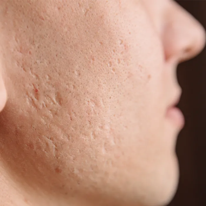 Acne Scar treatment in hyderabad, india