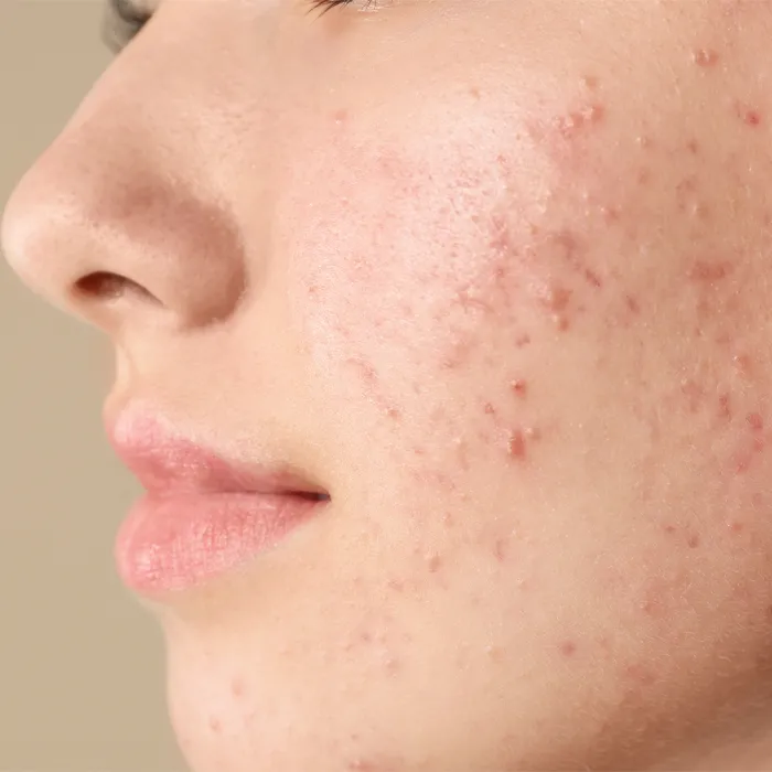 Acne Treatment in Hyderabad India