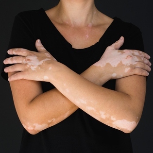 Phototherphy Vitiligo Treatment