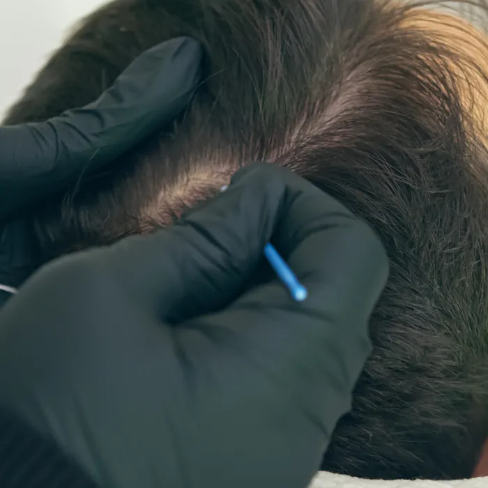 Scalp Micropigmentation in Hyderabad