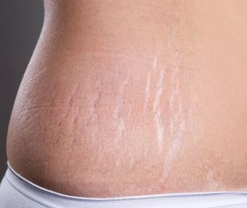 Stretch Marks Removal in Hyderabad