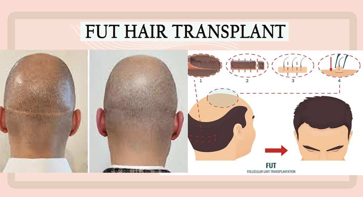 FUT-Hair-Transplant