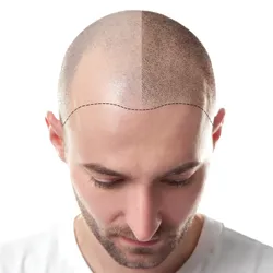 Scalp Micropigmentation