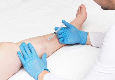 Sclerotherapy Treatment in Hyderabad