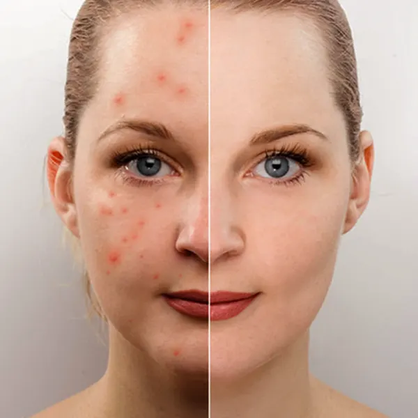 Acne Scar Surgery Treatment