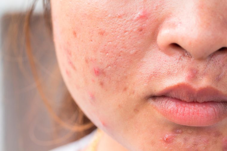 Acne Scars treatment