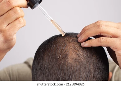 Best Hair loss Treatment in Hyderabad